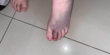 Dvaneastogodišnjakinju ujeo poskok u Konjević Polju