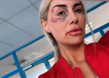Selma Bajrami u modricama, završila u bolnici Selma Bajrami u modricama, završila u bolnici
